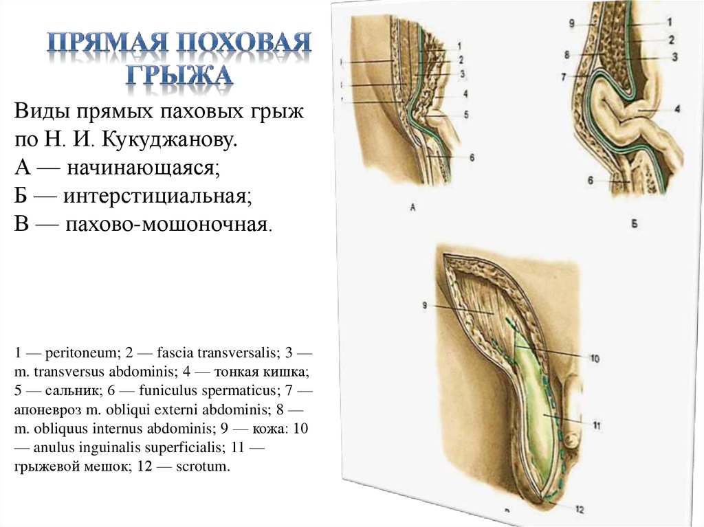 Паховая грыжа у мужчин где находится картинка причины симптомы и лечение