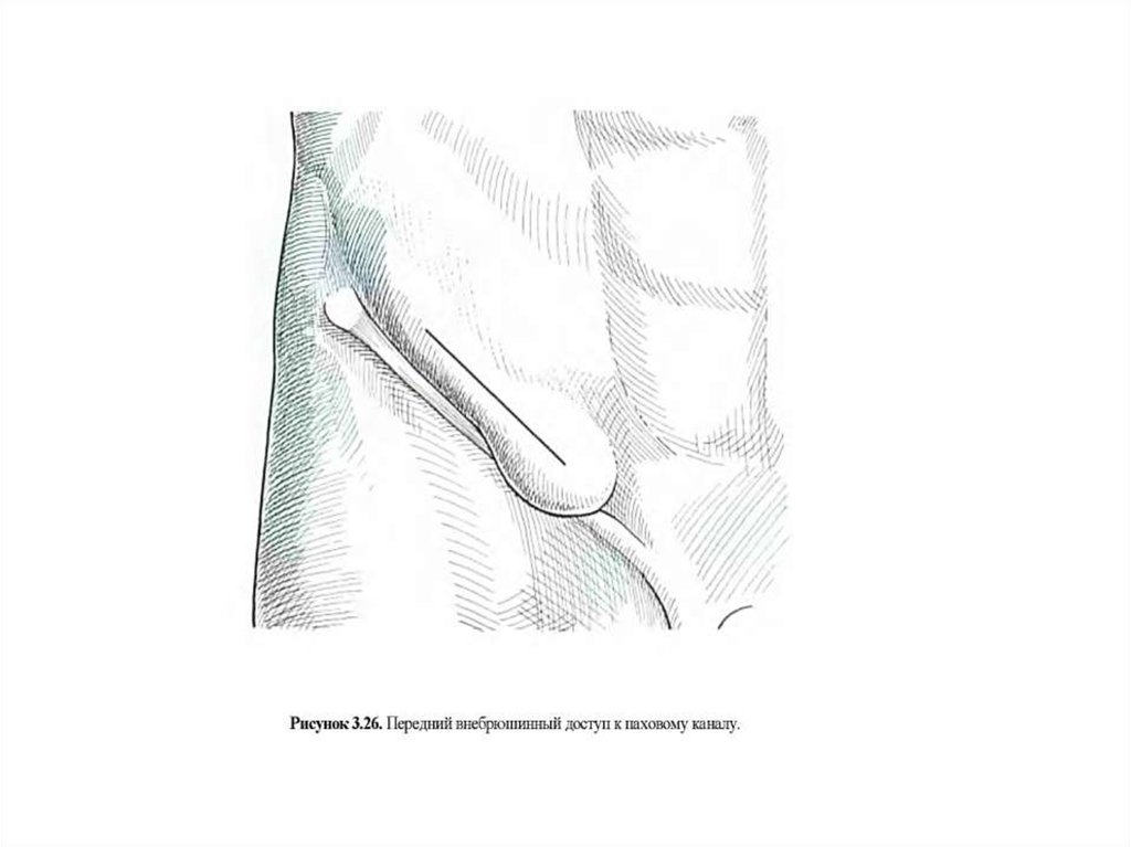 Паховая грыжа рисунок