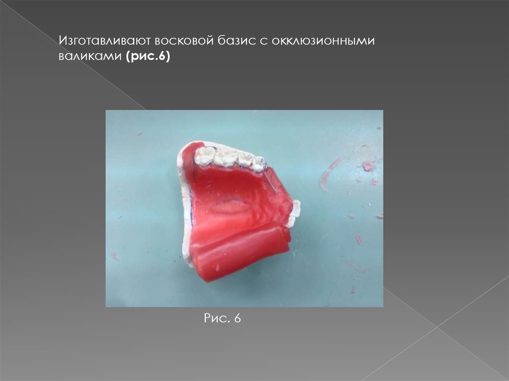 Изготовление воскового базиса с окклюзионными валиками презентация