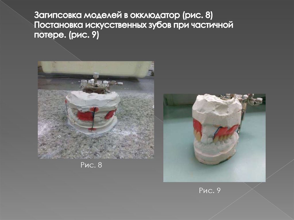 Изготовление воскового базиса с окклюзионными валиками презентация