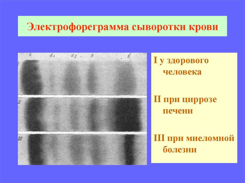 М градиент при электрофорезе белков сыворотки крови. Нормальная Электрофореграмма белков сыворотки крови. Электрофореграмма здорового человека. Электрофорез при миеломной болезни.