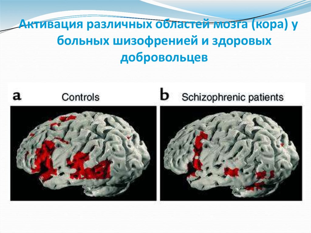 Генетика шизофрении презентация