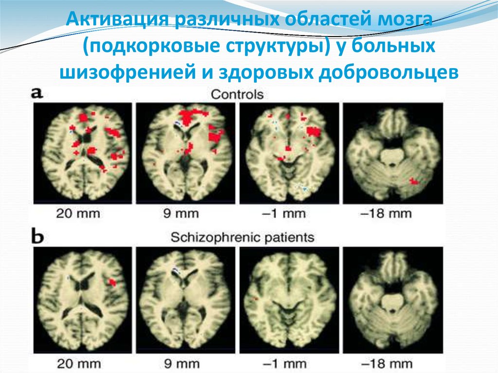 Шизофрения мозг фото