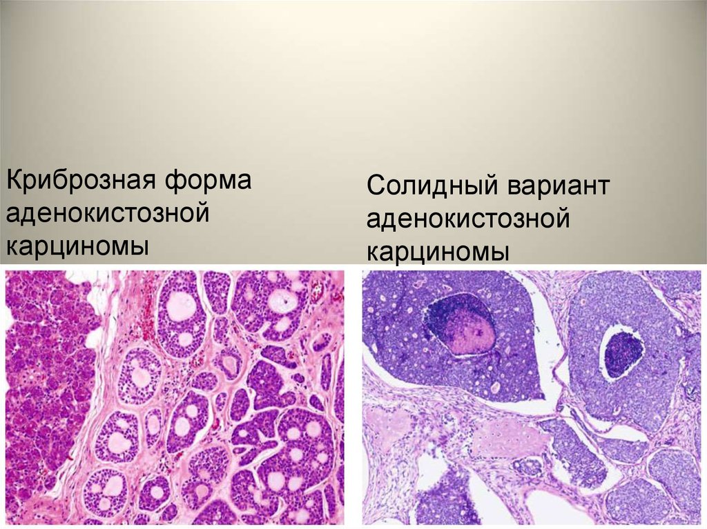 Патология желез. Цилиндрома гистология. Микропрепарат аденокистозная карцинома слюнной железы. Цилиндрома слюнной железы гистология. Аденокарцинома слюнной железы гистология.