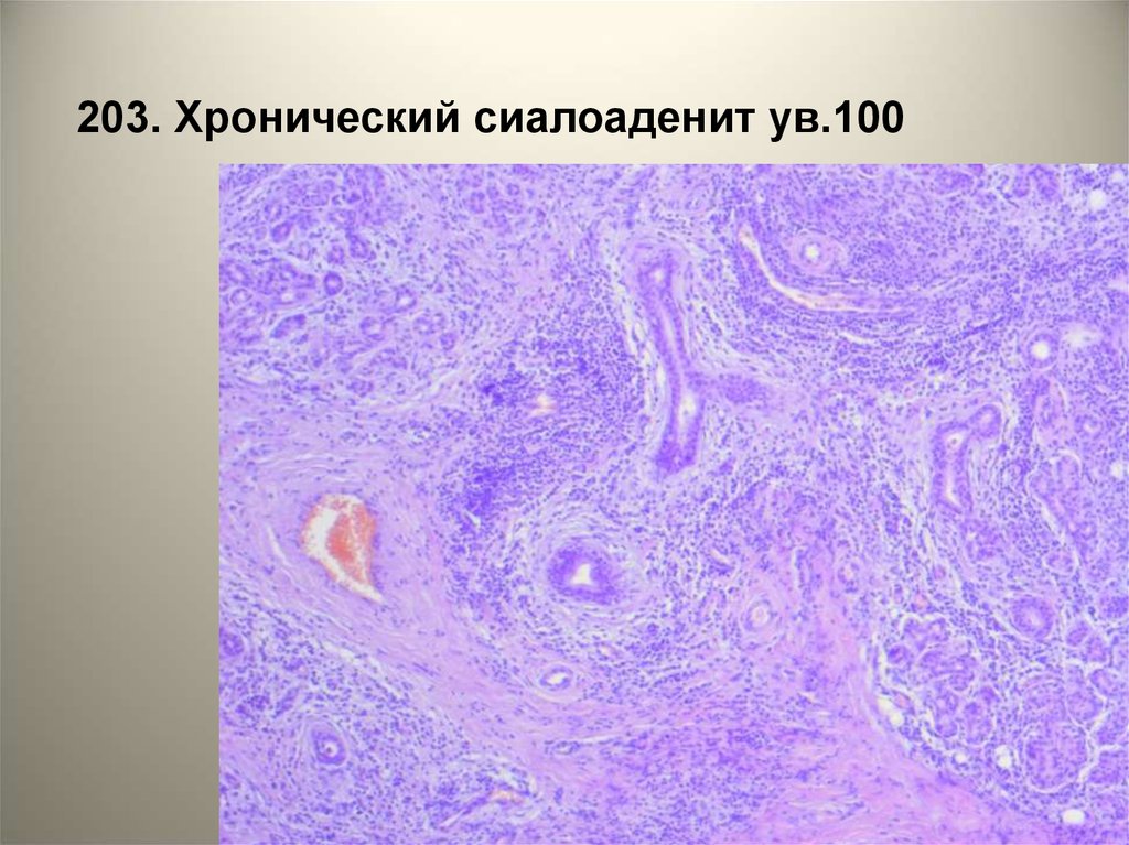 Патология желез. Острый сиалоаденит гистология. Сиалоаденит патологическая анатомия. Хронический сиалоаденит гистология. Калькулезный сиалоаденит гистология.