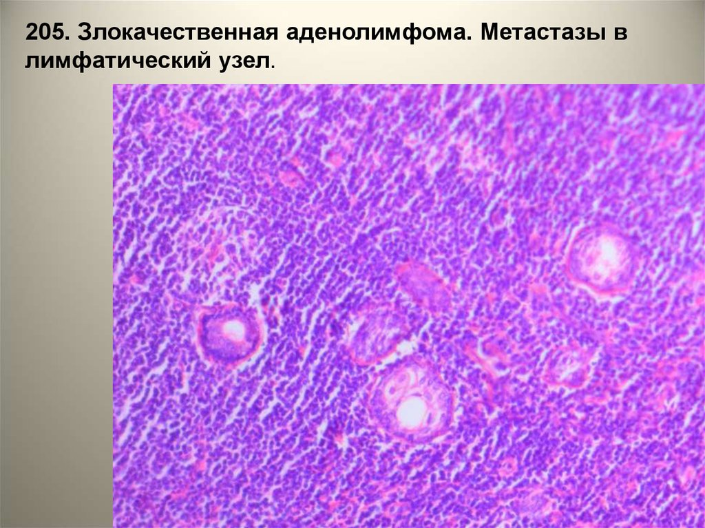 Метастаз рака в лимфатический узел. Аденолимфома гистология. Метастаз в лимфоузел микропрепарат. Метастазы в лимфоузлах микропрепарат. Метастаз меланомы в лимфатический узел микропрепарат.