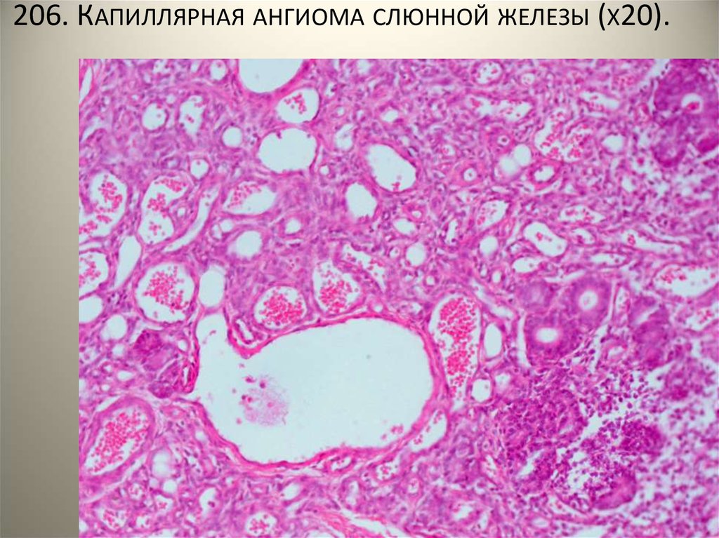 Доброкачественные и злокачественные опухоли слюнных желез презентация