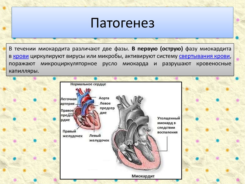 Миокардит картинки для презентации