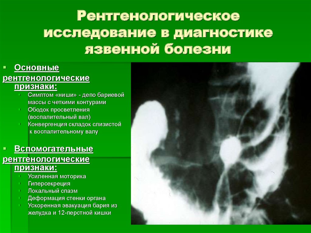 Перфоративная язва симптомы. Перфоративная язва желудка рентген. Рентген симптомы язвы желудка. Рентгенологическая диагностика язвенной болезни желудка и ДПК.. Язва ДПК рентген признаки.