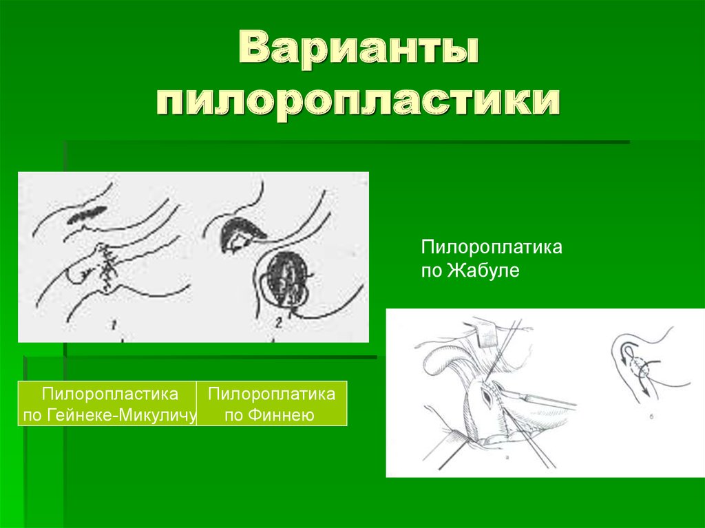 Пилоропластика по финнею схема