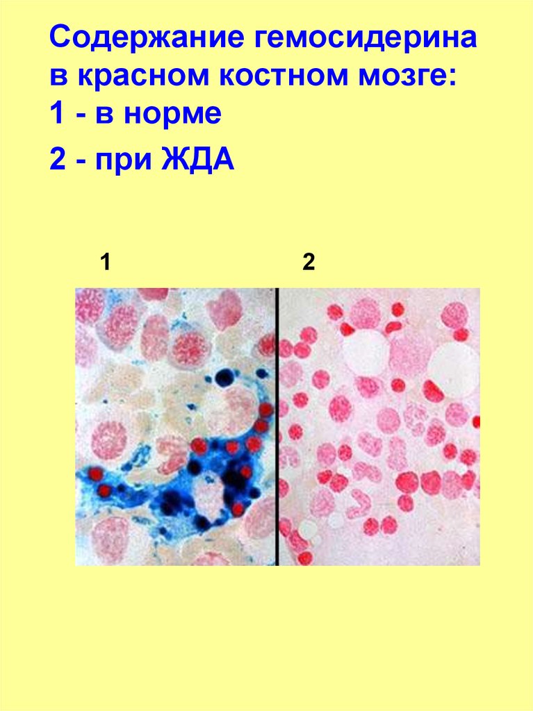 Картина крови при жда