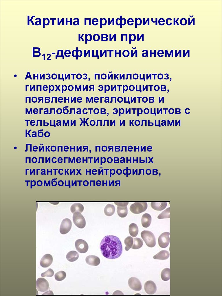 Пойкилоцитоз анемия. Картина периферической крови при в12 дефицитной анемии. В12 дефицитная анемия гиперхромная. В12 анемия эритроциты гиперхромная. Эритроциты при в 12 анемии.