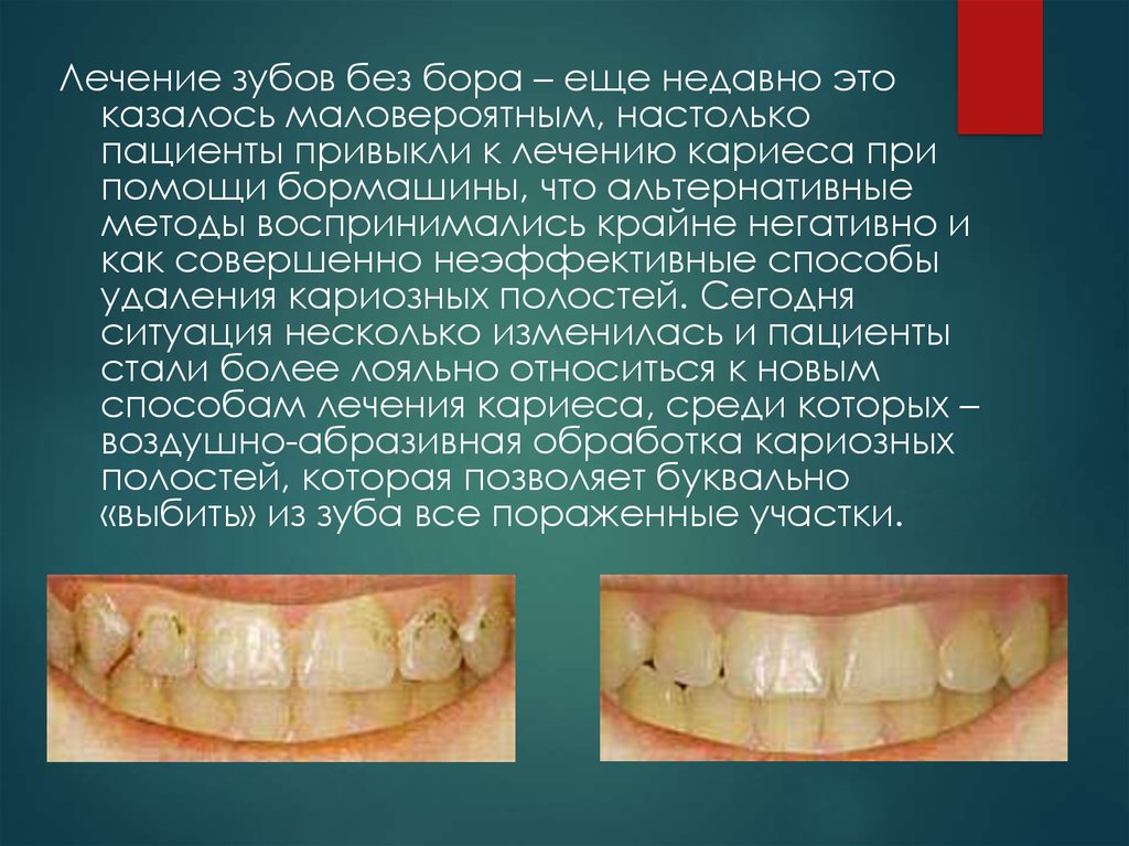 Абразивный метод. Воздушно-абразивный метод препарирования зубов. Воздушно-абразивный метод в стоматологии. Воздушно-абразивная методика лечения кариеса. Воздушно абразивная методика препарирования.