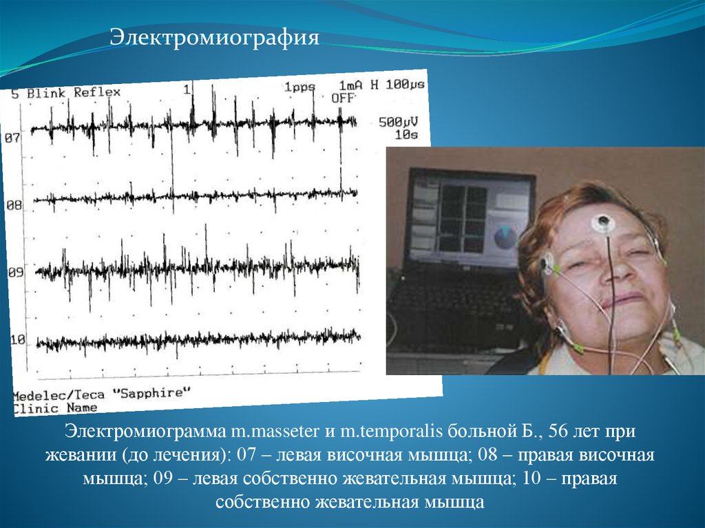 Эмг самара. Электромиография (EMG) В стоматологии. Электромиография и электронейромиография. Показатели электромиографии жевательных мышц в норме. Электромиография методика.