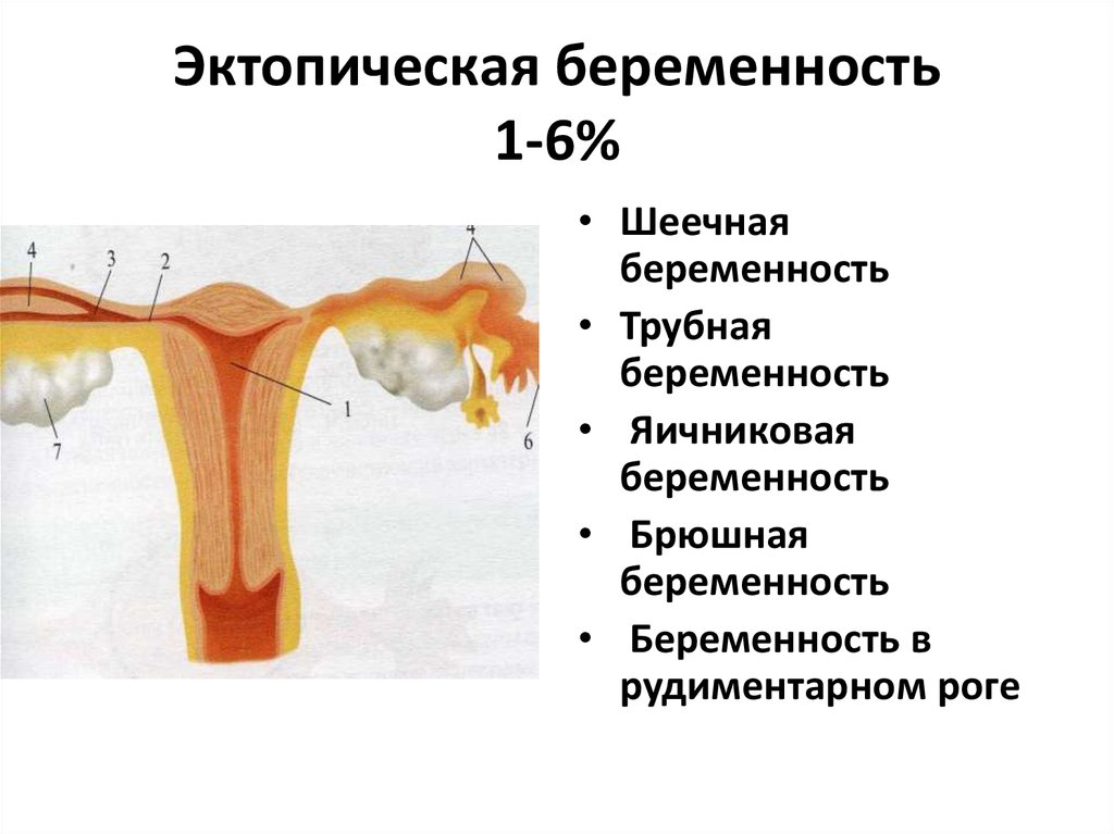 Эктопическая беременность презентация