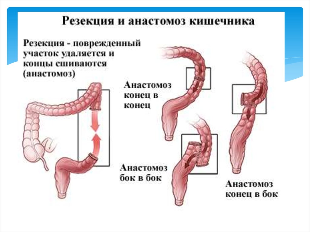 Симптомы операция кишечнике. Резекция ободочной и анастомоз. Анастомоз Толстого кишечника. Резекция толстой кишки с анастомозом. Аппаратный анастомоз сигмовидной кишки.