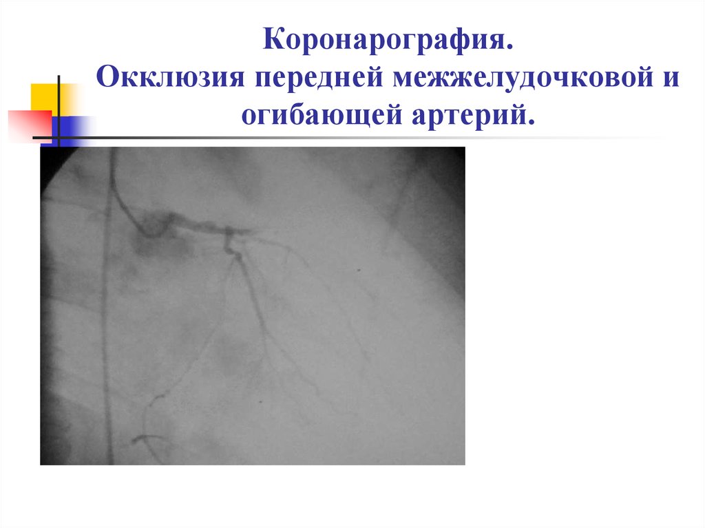 Коронарная окклюзия. Инфаркт миокарда коронарография. Коронарография при инфаркте миокарда заключение. Коронарография окклюзия. Коронароангиография при инфаркте миокарда заключение.