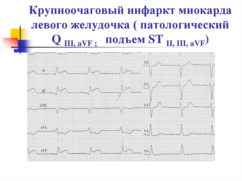 Признаки трансмурального инфаркта. Мелкоочаговый инфаркт на ЭКГ. Мелкоочаговый инфаркт миокарда на ЭКГ. Крупноочаговый и мелкоочаговый инфаркт миокарда на ЭКГ. Крупноочаговый трансмуральный инфаркт ЭКГ.