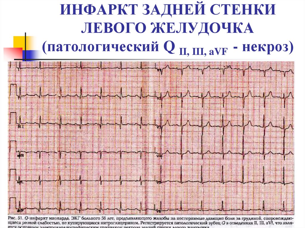 Изменения миокарда левого желудочка сердца. Острый инфаркт миокарда задней стенки на ЭКГ. ЭКГ при инфаркте миокарда задней стенки. ЭКГ при инфаркте передней и задней стенки. Стенки инфаркта миокарда на ЭКГ.