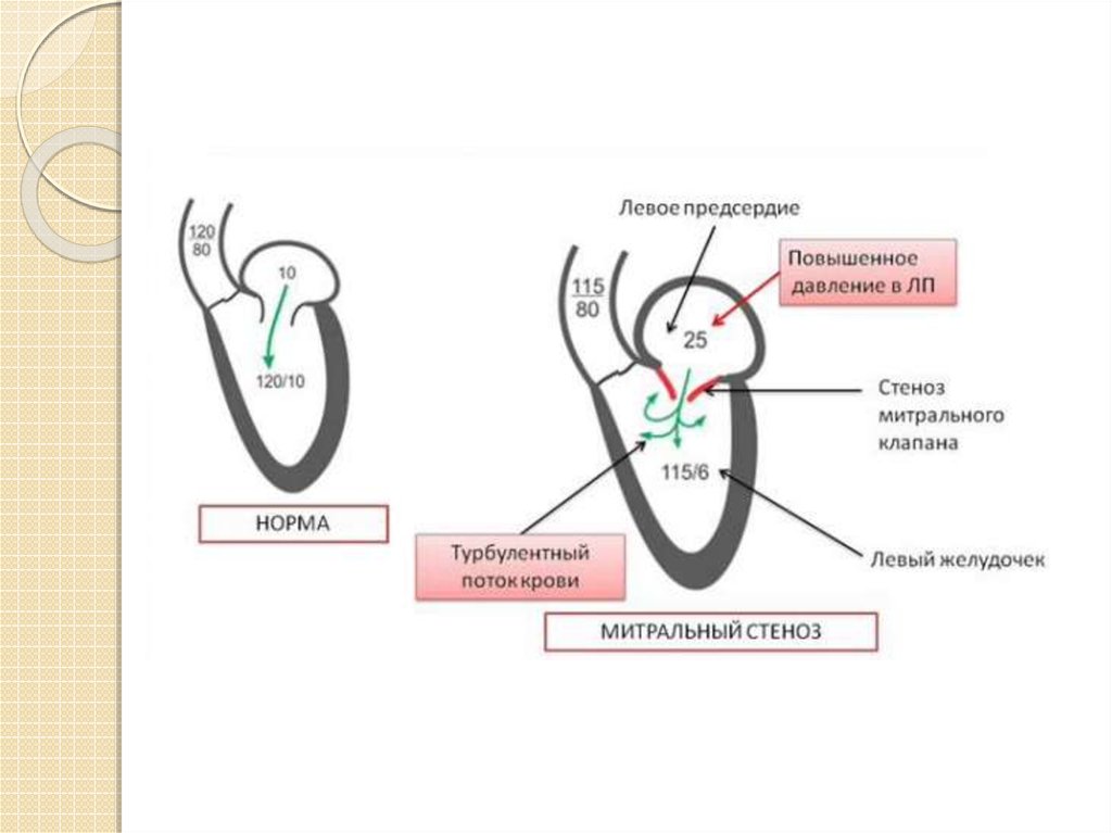 Стеноз митрального клапана презентация - 88 фото