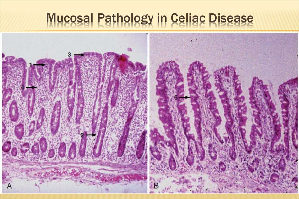 Celiac Disease Online Presentation