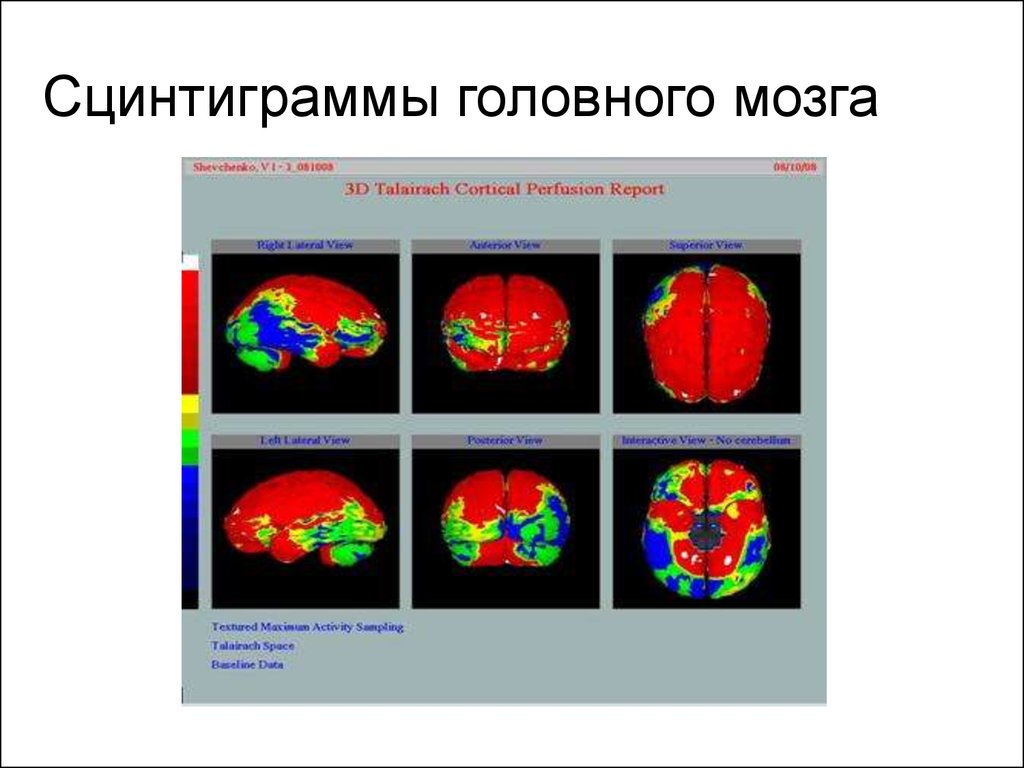 Диагностика головного. Перфузионная сцинтиграфия головного мозга. Динамическая радионуклидная сцинтиграфия головного мозга. ОФЭКТ головного мозга. Перфузионная ОФЭКТ головного мозга.