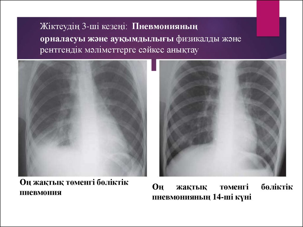 Пневмония презентация казакша