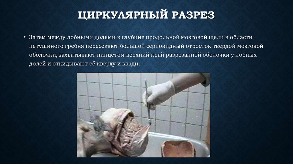 Циркулярный разрез