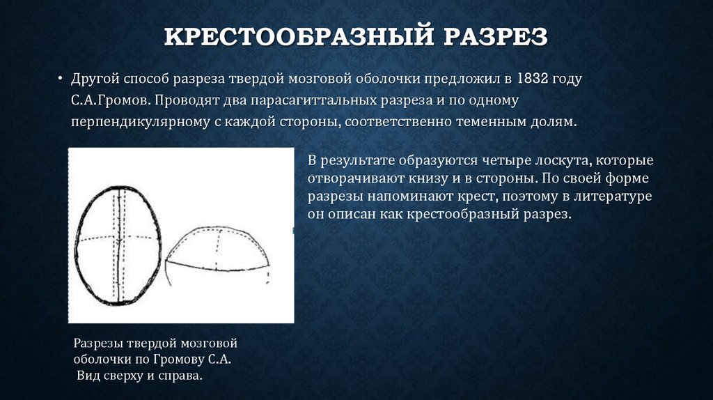 Крестообразный разрез