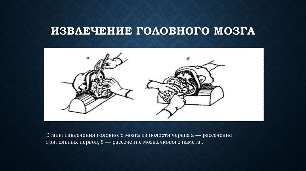 Извлечение головного мозга