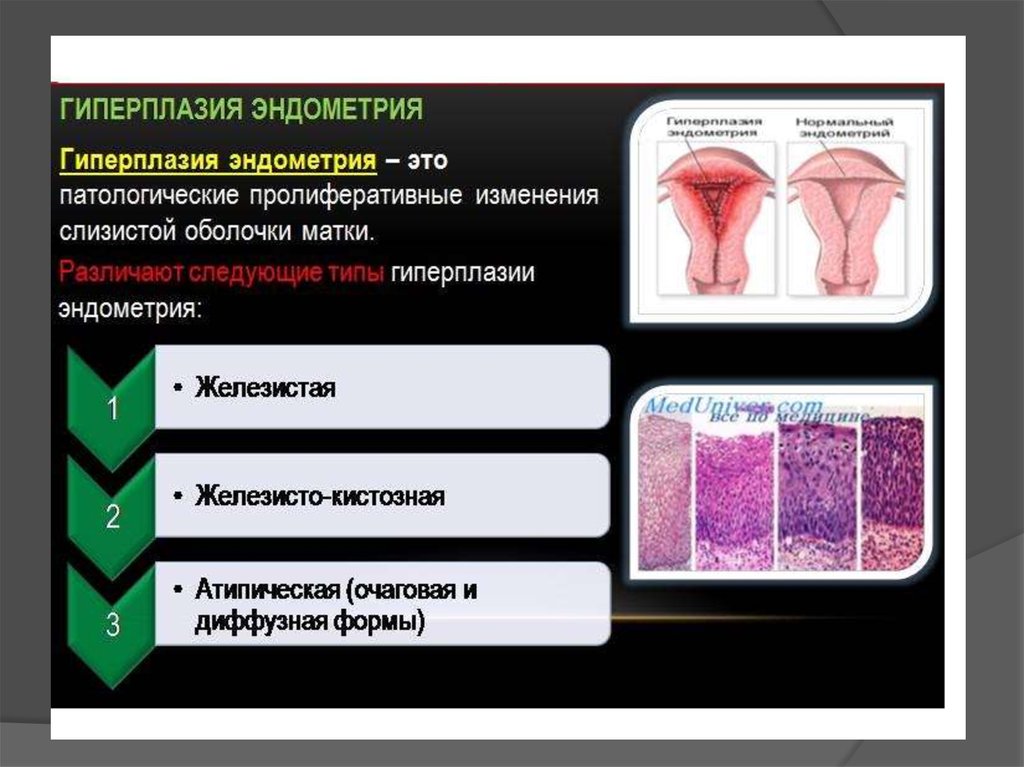 Гиперплазия эндометрия 10
