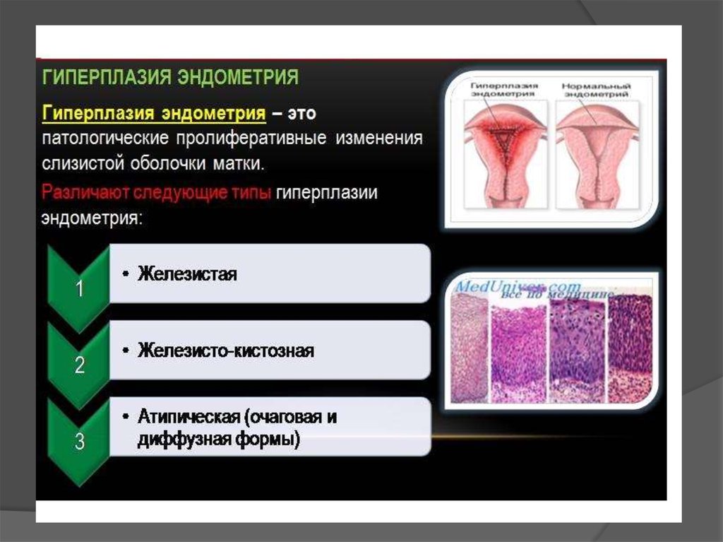 Гиперплазия матки что это. Гиперплазия эндометрия. Гиперплазия эндометрия классификация. Железистая гиперплазия эндометрия патогенез.