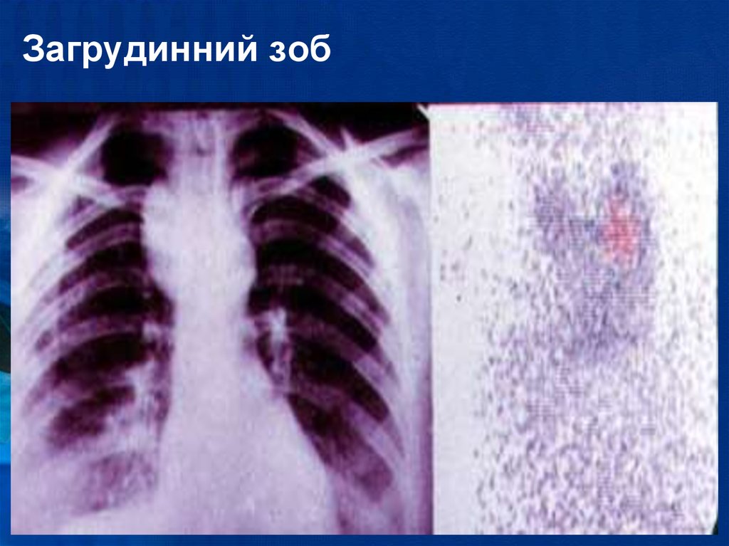 Пищевод зоб. Загрудинный зоб рентген. Загрудинный зоб щитовидной железы рентген. Загрудинный зоб рентген кт.