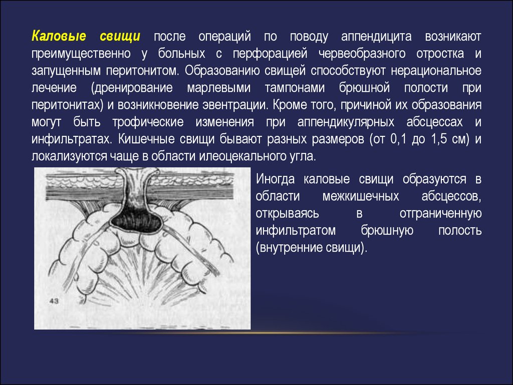 Профилактика свищей. Послеоперационный свищ. Свищ после операции на брюшной полости.