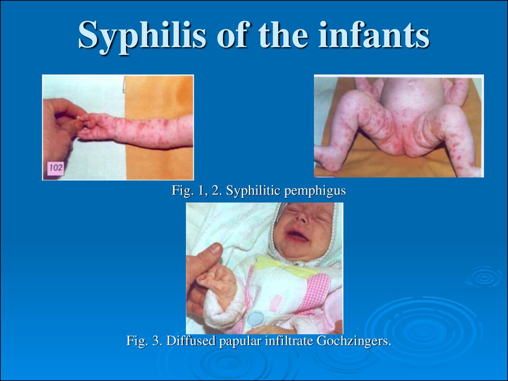 Tertiary, visceral syphilis, neurosyphilis - презентация онлайн