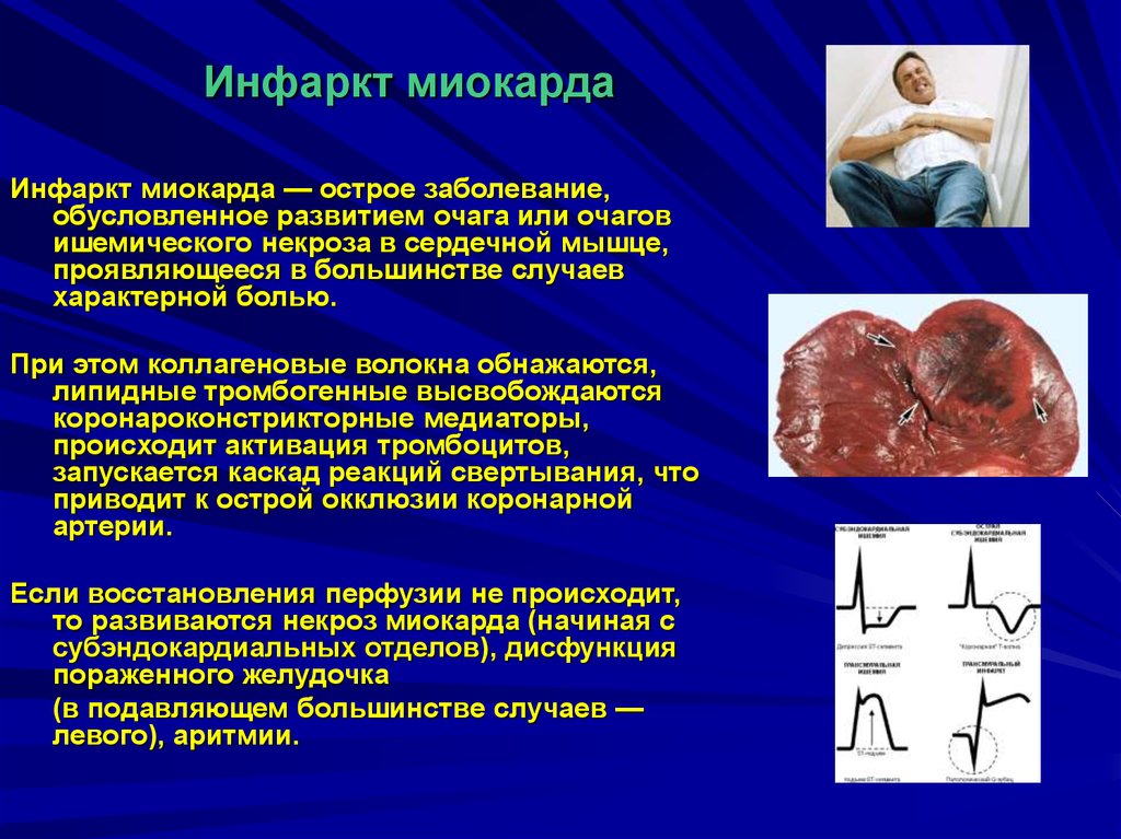 Инфаркт миокарда