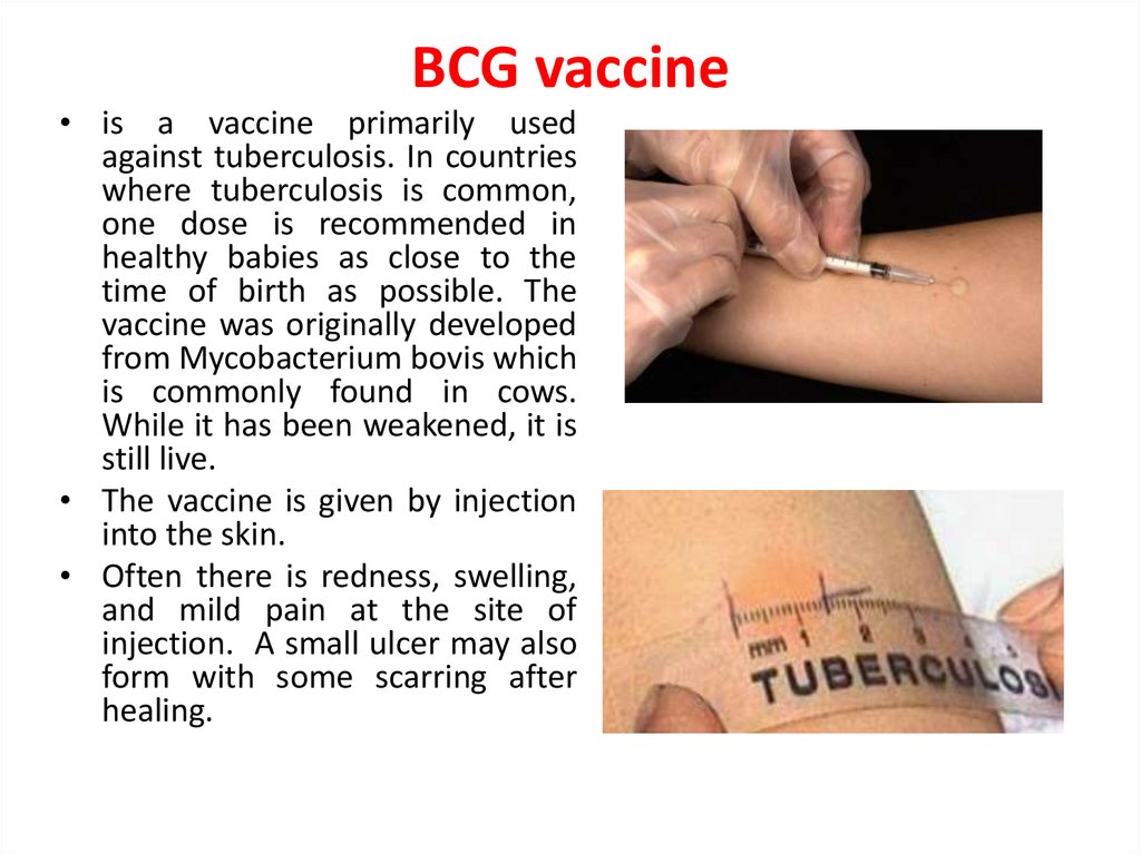 BCG vaccine