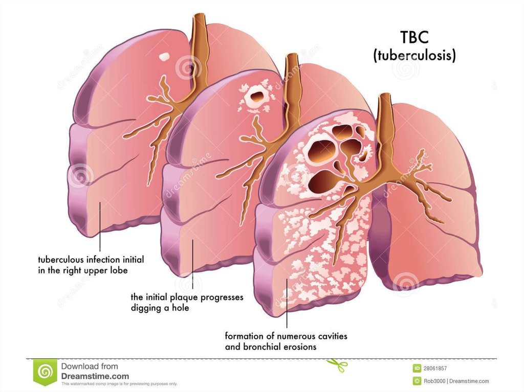 What Is Causative Agent Of Tuberculosis