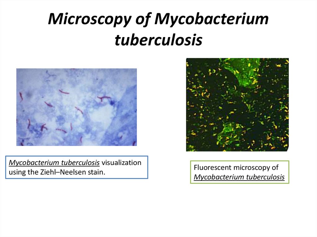 Microscopy of Mycobacterium tuberculosis