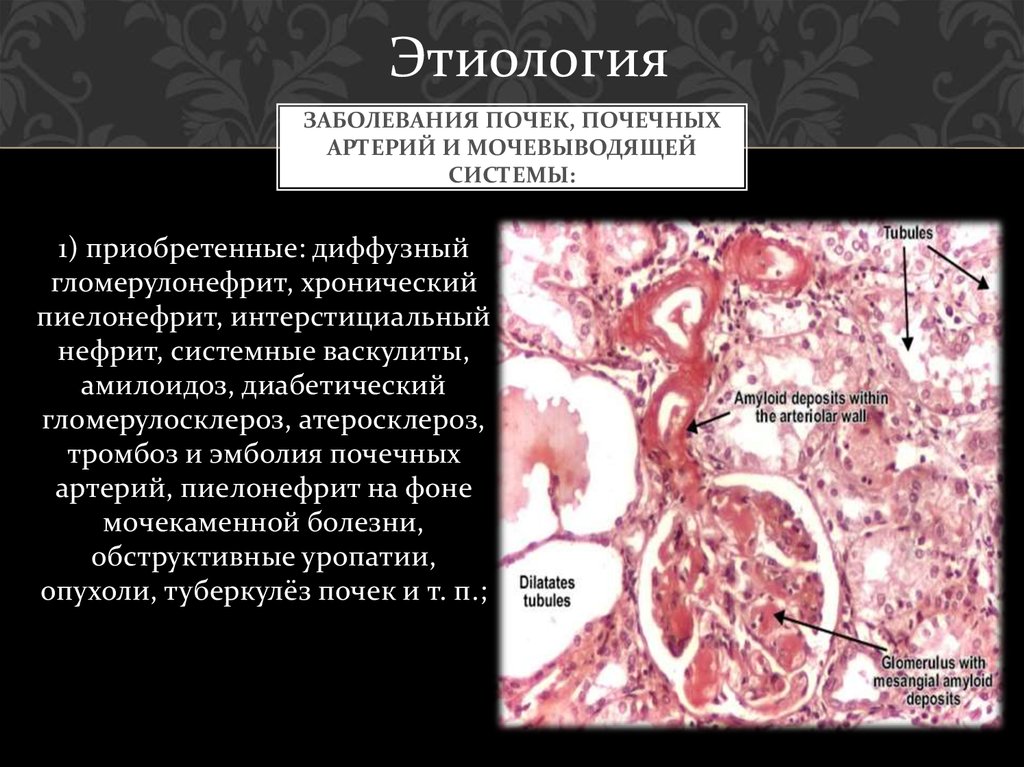 Заболевания почек, почечных артерий и мочевыводящей системы: