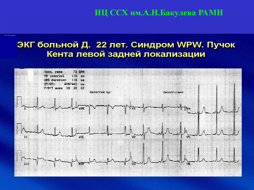 Преобладание потенциалов левого желудочка на экг