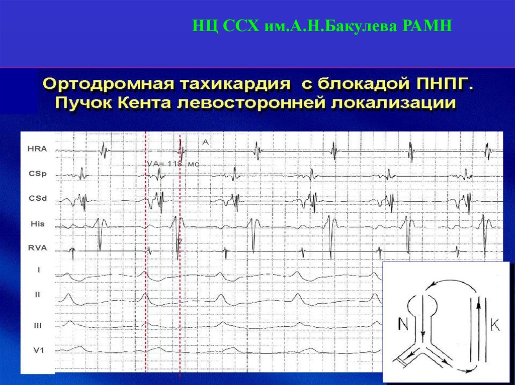 Синдром желудочков на экг. Диаграмма сердечно сосудистая хирургия. Таблицы по сердечно сосудистой хирургии. Лопатки в сердечно-сосудистой хирургии. Причины ССХ.