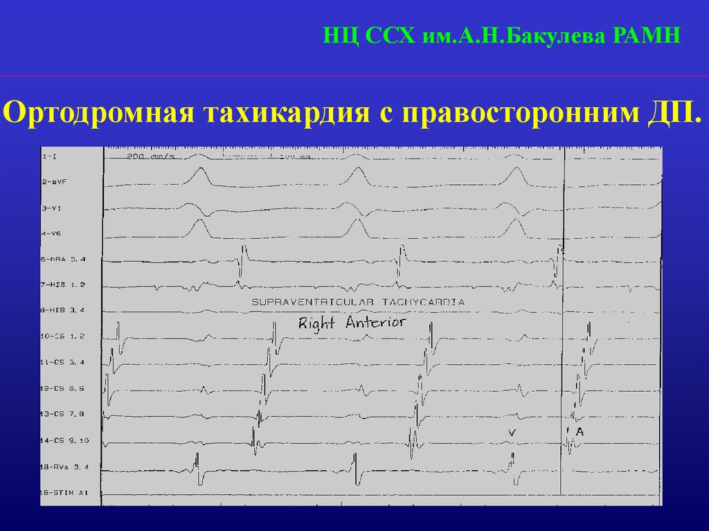 Диагностические варианты. Ортодромная тахикардия. Синдром предвозбуждения желудочков Бахмана. Синдром предвозбуждения желудочков с отрицательным p.