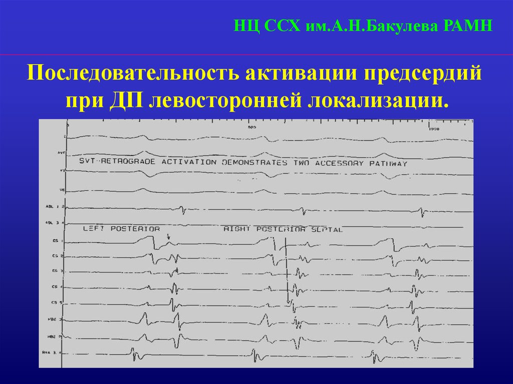 Варианты диагностики. Синдром предвозбуждения желудочков Бахмана. Левосторонняя локализация КРР. Диаграмма сердечно сосудистая хирургия. Классификация Бакулева-Дамир.