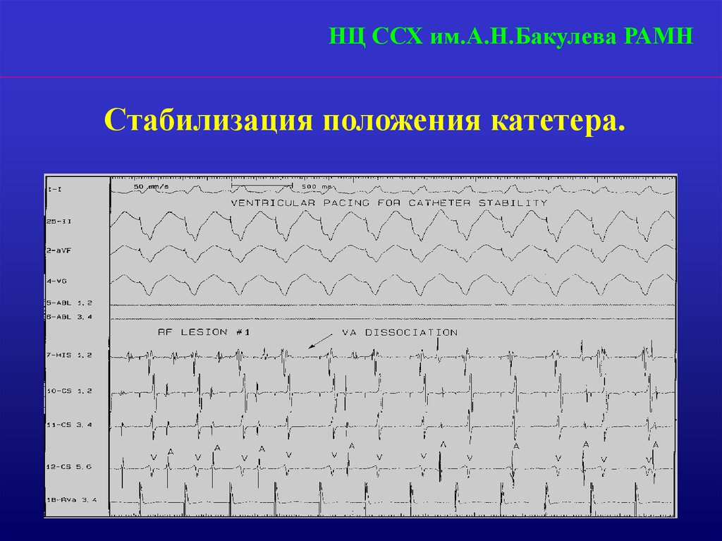 Диагностические варианты. Синдром предвозбуждения желудочков Бахмана. Диаграмма сердечно сосудистая хирургия. Положение стабилизировано.