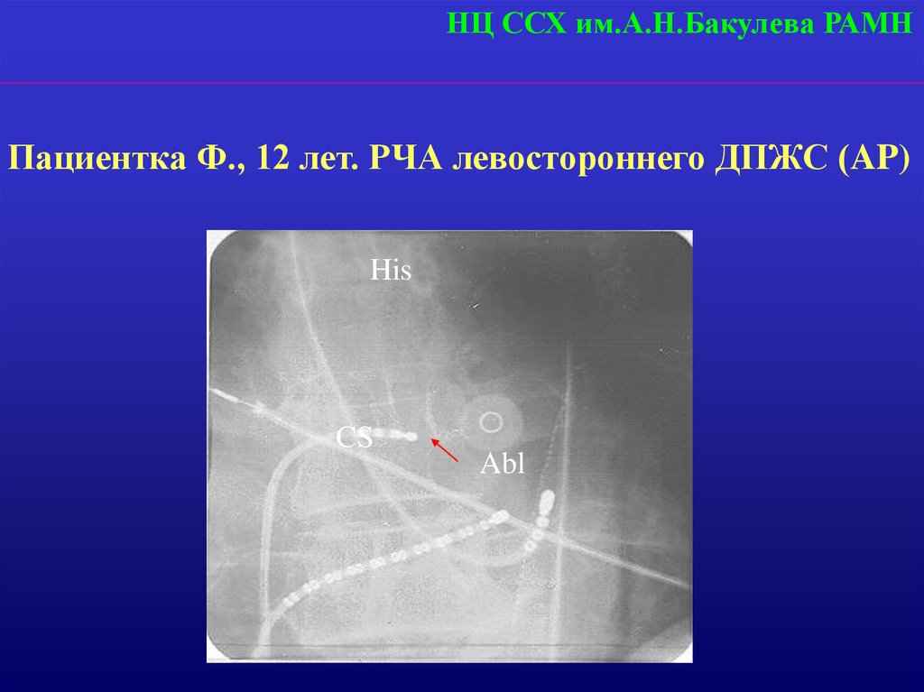 Рча пищевода. Абляция Бакулева радиочастотная катетерная. Радиочастотная абляция ДПЖС.