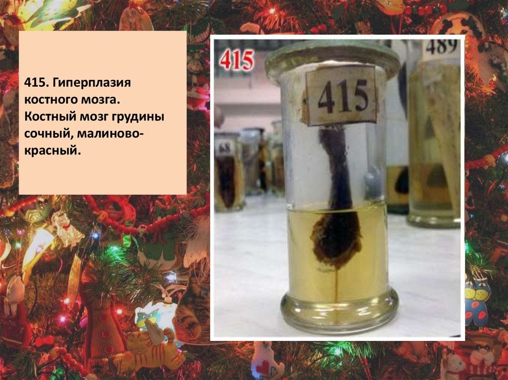 415. Гиперплазия костного мозга. Костный мозг грудины сочный, малиново-красный.  