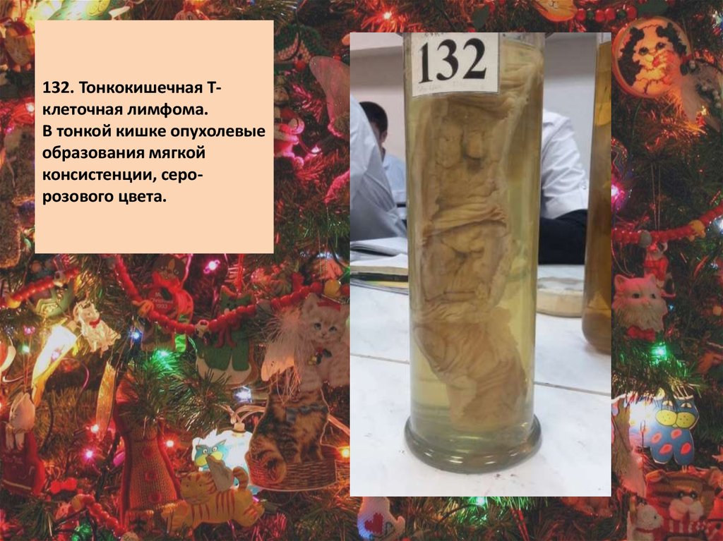 132. Тонкокишечная Т-клеточная лимфома. В тонкой кишке опухолевые образования мягкой консистенции, серо-розового цвета.