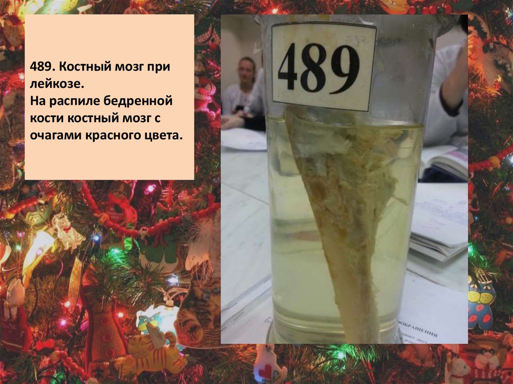 489. Костный мозг при лейкозе. На распиле бедренной кости костный мозг с очагами красного цвета.  