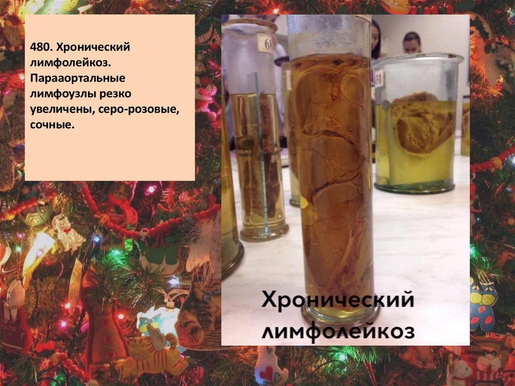 480. Хронический лимфолейкоз. Парааортальные лимфоузлы резко увеличены, серо-розовые, сочные.  